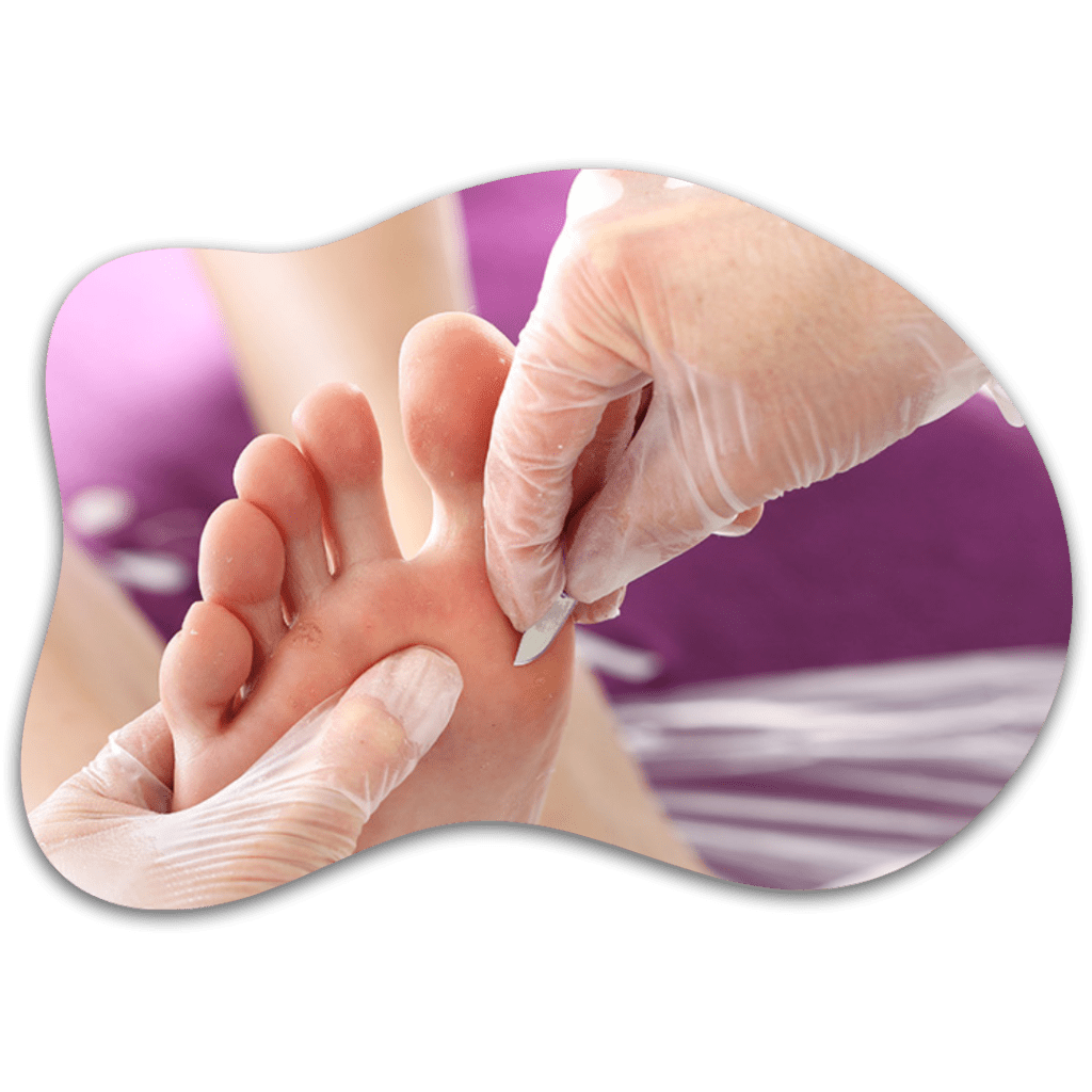 Quiropodia para durezas y callos