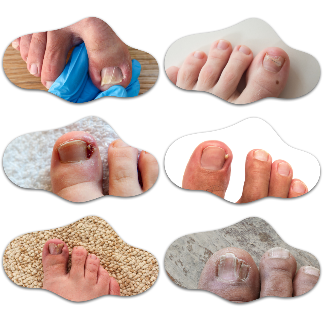 Reeducación ungueal: guía y protección de la uña