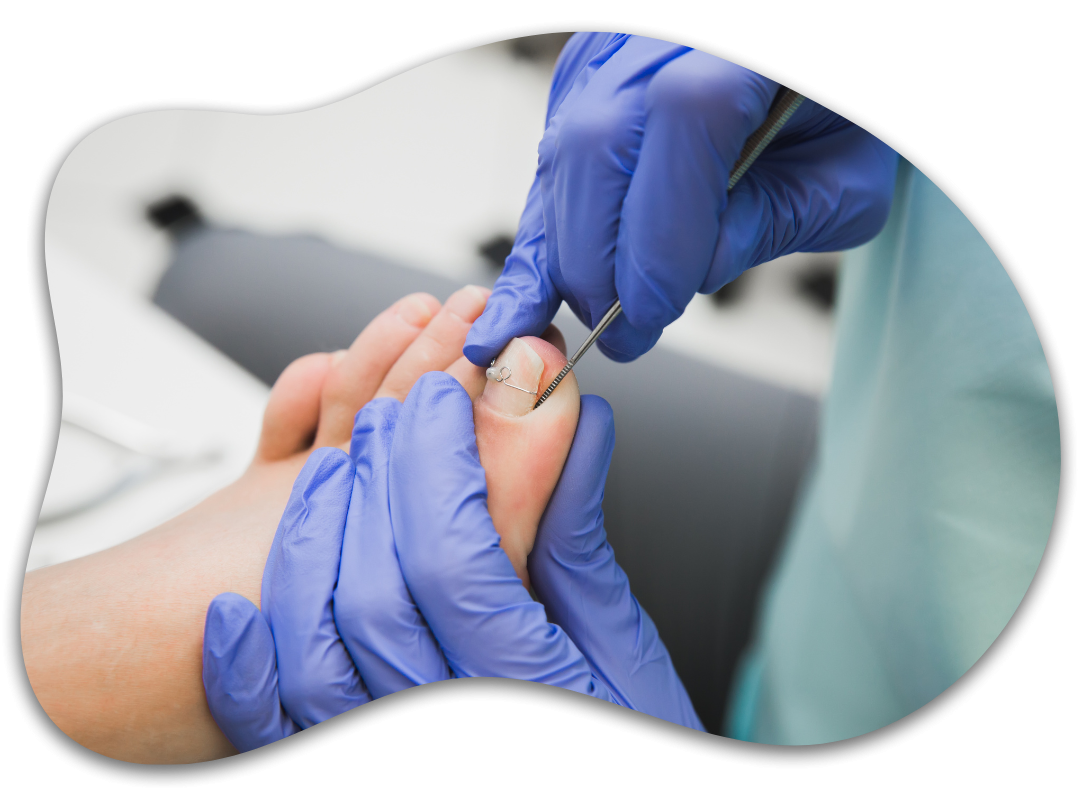 Resultado estético natural en reconstrucción de uña