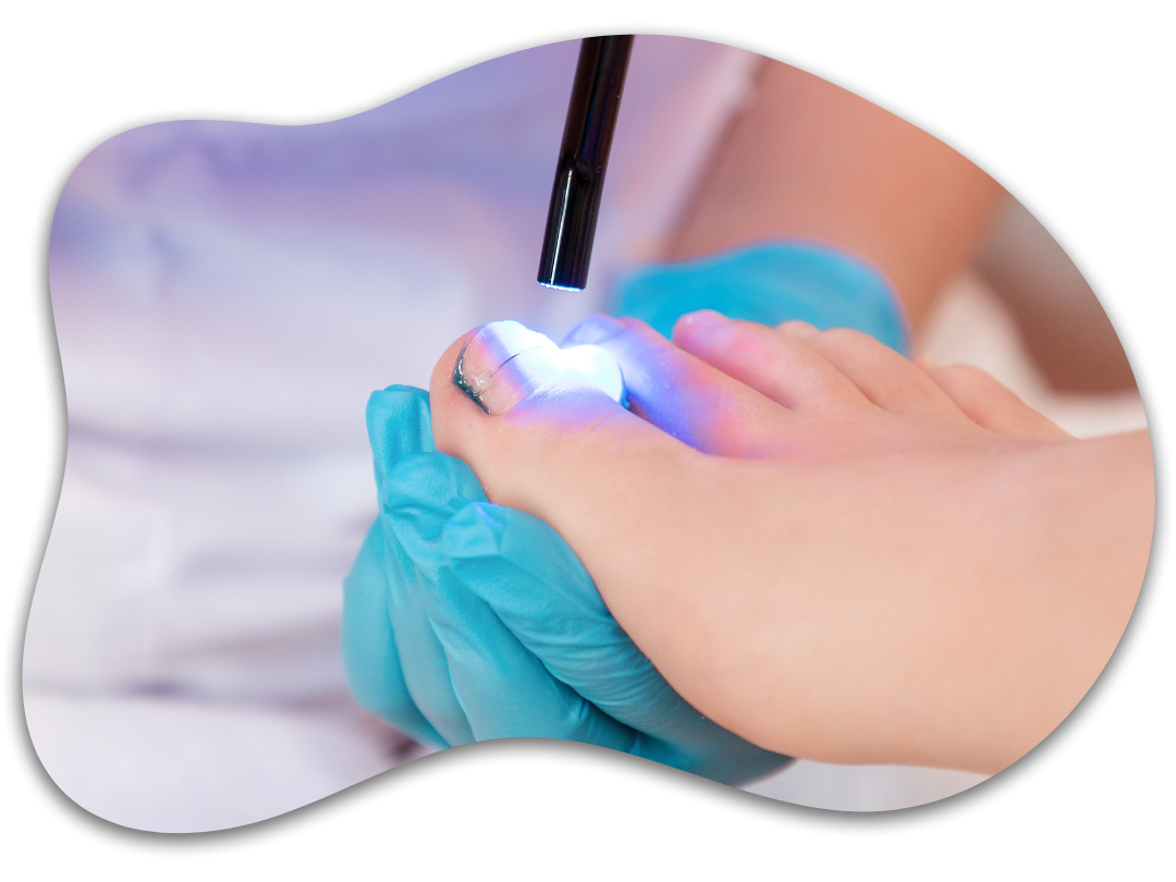 Reconstrucción ungueal clínica en Sabadell