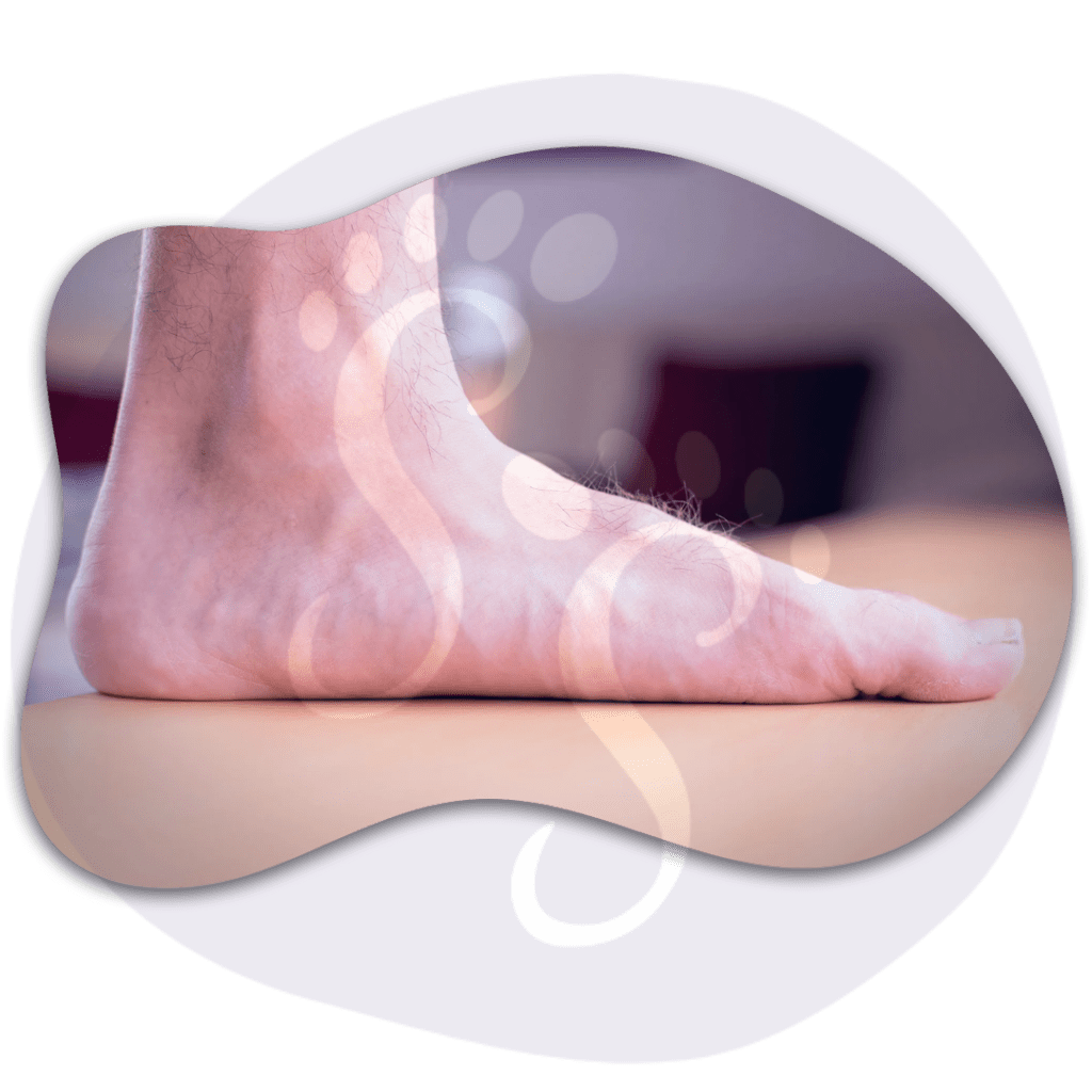 Todo lo que Necesitas Saber sobre el Pie Plano: Causas, Síntomas y Tratamientos&nbsp;Efectivos