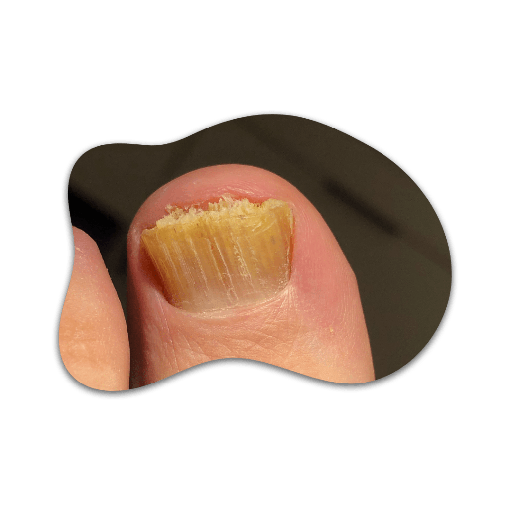 Tratamiento láser para hongos en las uñas