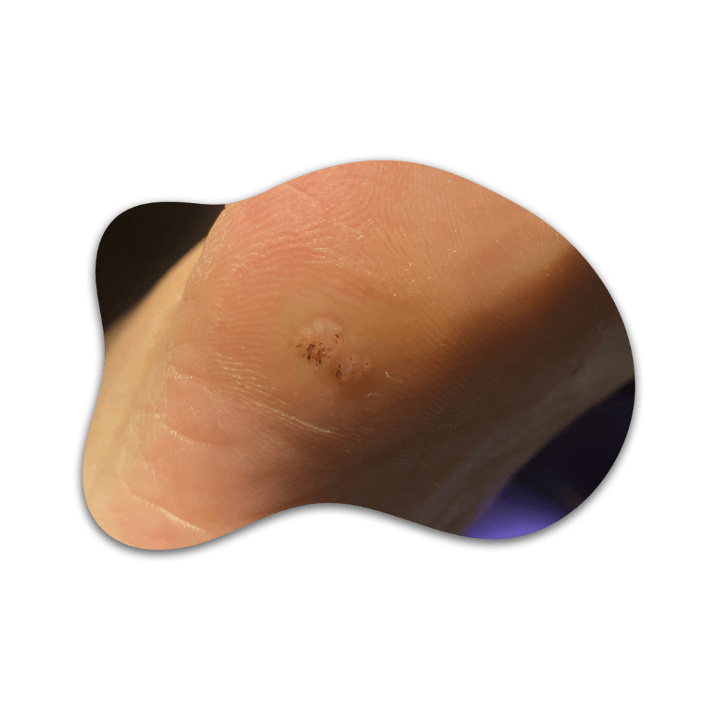 Tratamiento de verrugas plantares